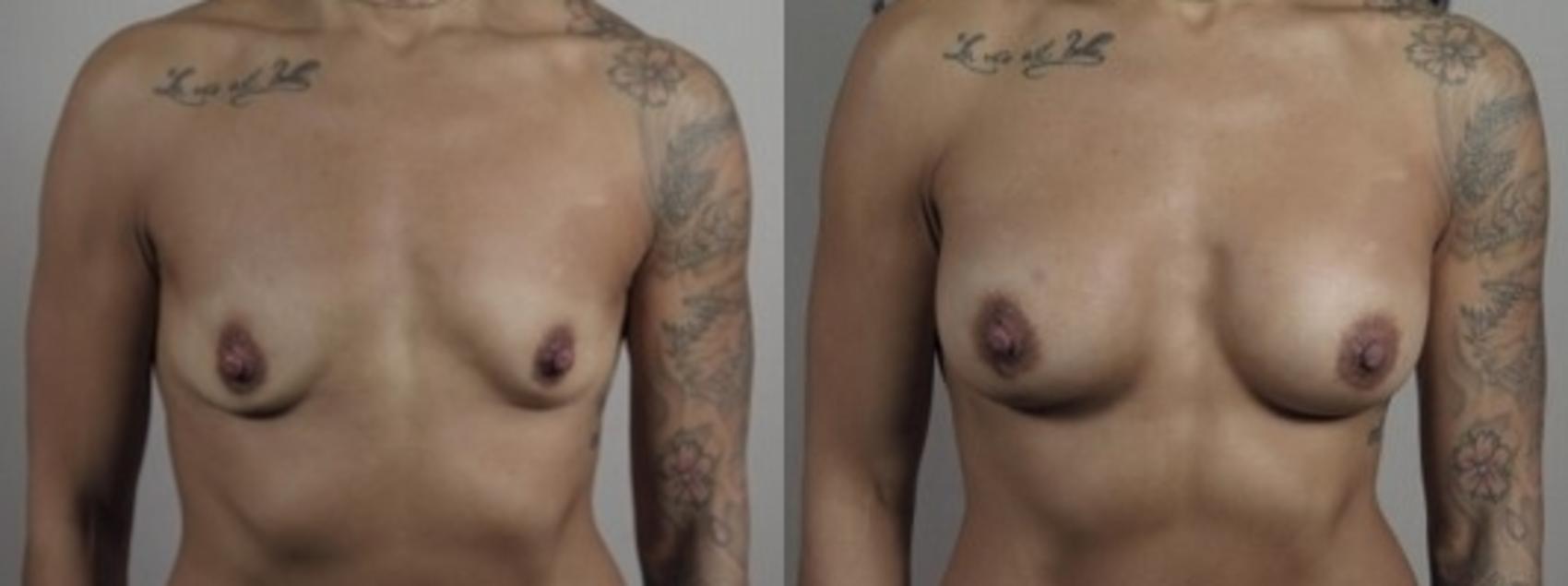 Mommy Makeover Case 1243 Before & After Front | Paramus, New Jersey | Parker Center for Plastic Surgery