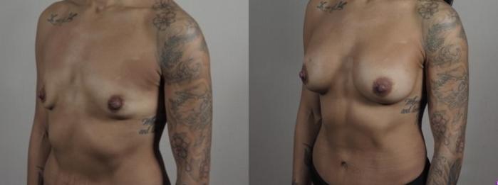 Mommy Makeover Case 1243 Before & After Left Oblique | Paramus, New Jersey | Parker Center for Plastic Surgery