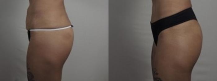 Mommy Makeover Case 1243 Before & After Left Side | Paramus, New Jersey | Parker Center for Plastic Surgery