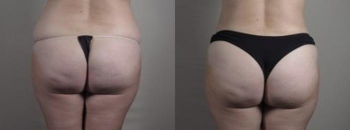 Mommy Makeover Case 1250 Before & After Back | Paramus, New Jersey | Parker Center for Plastic Surgery