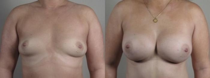 Mommy Makeover Case 1250 Before & After Front | Paramus, New Jersey | Parker Center for Plastic Surgery