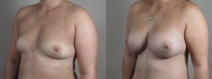Mommy Makeover Case 1250 Before & After Left Oblique | Paramus, New Jersey | Parker Center for Plastic Surgery