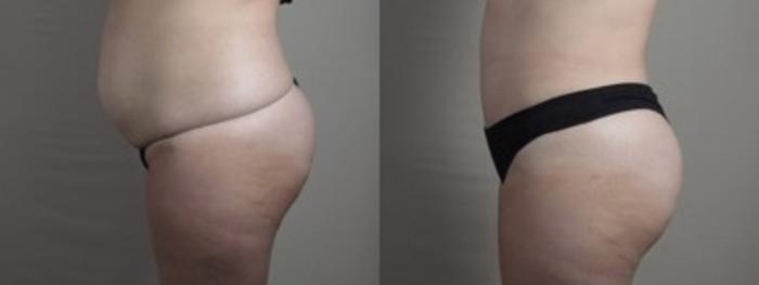 Mommy Makeover Case 1250 Before & After Left Side | Paramus, New Jersey | Parker Center for Plastic Surgery