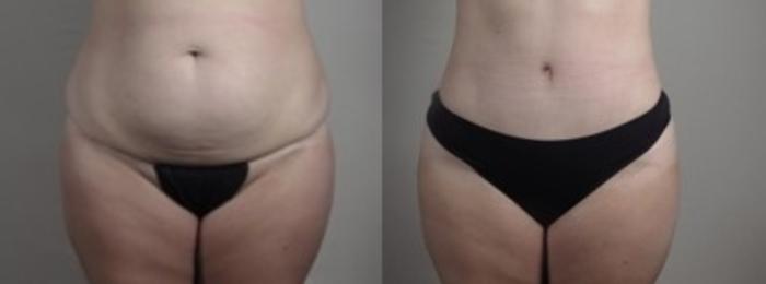 Mommy Makeover Case 1250 Before & After Lower Front  | Paramus, New Jersey | Parker Center for Plastic Surgery