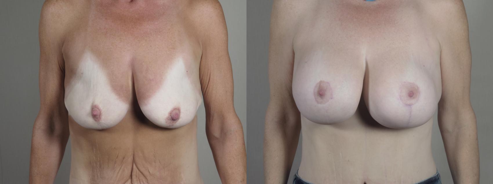 Mommy Makeover Case 1293 Before & After front | Paramus, New Jersey | Parker Center for Plastic Surgery