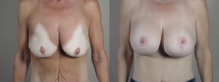 Mommy Makeover Case 1293 Before & After front | Paramus, New Jersey | Parker Center for Plastic Surgery
