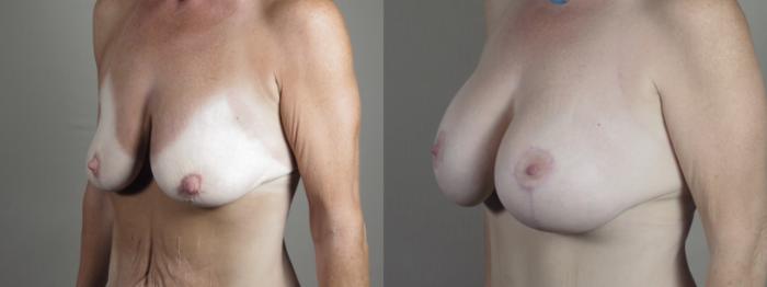 Mommy Makeover Case 1293 Before & After Left Oblique | Paramus, New Jersey | Parker Center for Plastic Surgery