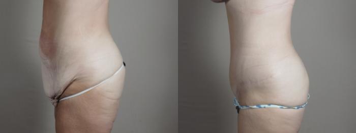 Mommy Makeover Case 1293 Before & After Left Side | Paramus, New Jersey | Parker Center for Plastic Surgery