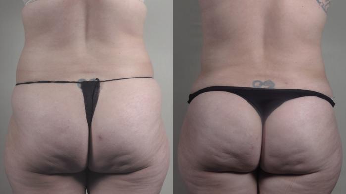 Mommy Makeover Case 1294 Before & After Back | Paramus, New Jersey | Parker Center for Plastic Surgery