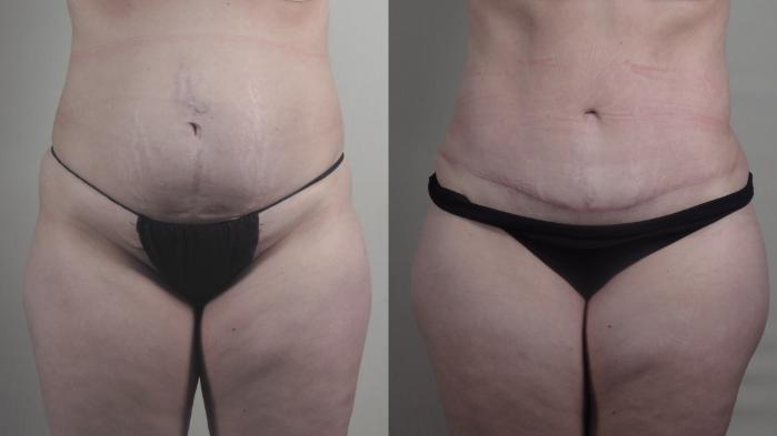 Mommy Makeover Case 1294 Before & After front  | Paramus, New Jersey | Parker Center for Plastic Surgery
