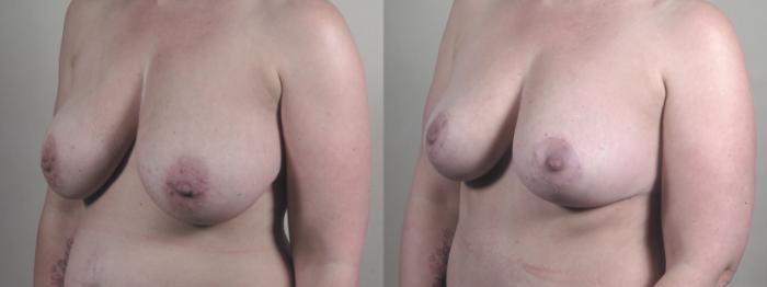 Mommy Makeover Case 1294 Before & After Left Oblique | Paramus, New Jersey | Parker Center for Plastic Surgery