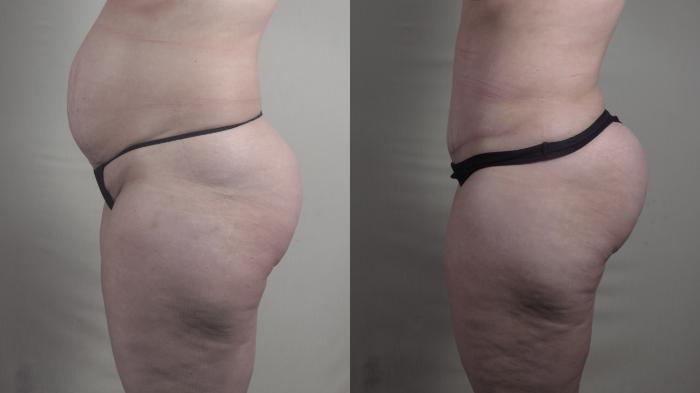 Mommy Makeover Case 1294 Before & After Left Side | Paramus, New Jersey | Parker Center for Plastic Surgery