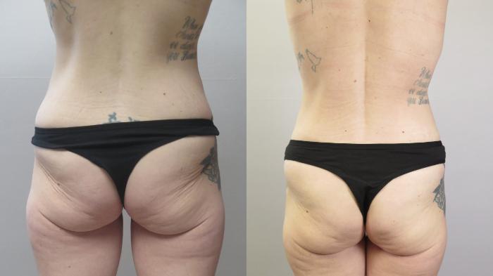 Mommy Makeover Case 1668 Before & After Back | Paramus, New Jersey | Parker Center for Plastic Surgery