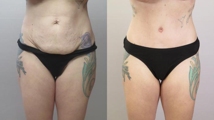 Mommy Makeover Case 1668 Before & After front 1 | Paramus, New Jersey | Parker Center for Plastic Surgery