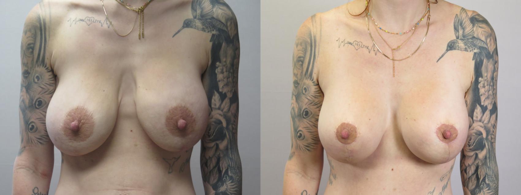 Mommy Makeover Case 1668 Before & After Front | Paramus, New Jersey | Parker Center for Plastic Surgery