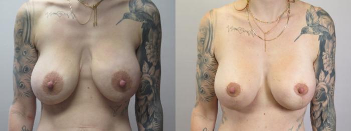 Mommy Makeover Case 1668 Before & After Front | Paramus, New Jersey | Parker Center for Plastic Surgery