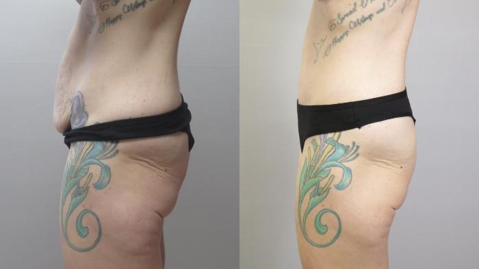 Mommy Makeover Case 1668 Before & After Left Side | Paramus, New Jersey | Parker Center for Plastic Surgery