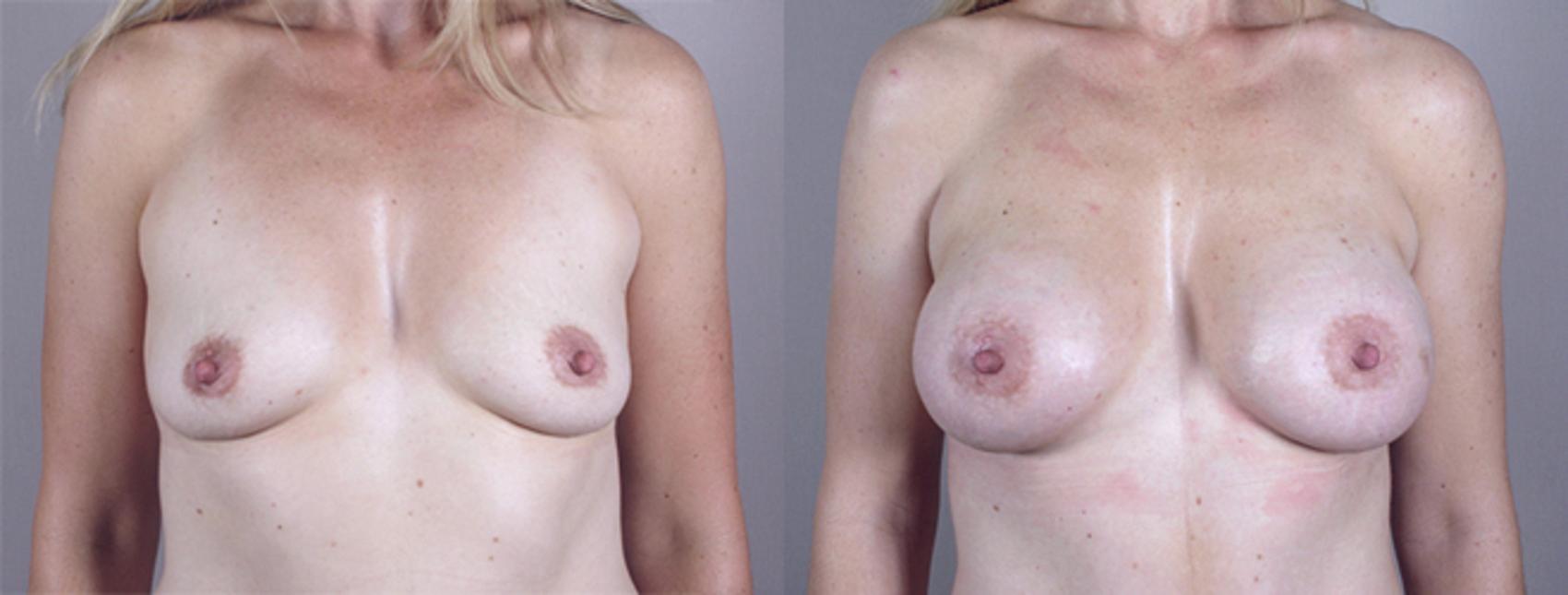 Mommy Makeover Case 376 Before & After View #1 | Paramus, New Jersey | Parker Center for Plastic Surgery