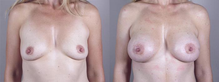 Mommy Makeover Case 376 Before & After View #1 | Paramus, New Jersey | Parker Center for Plastic Surgery