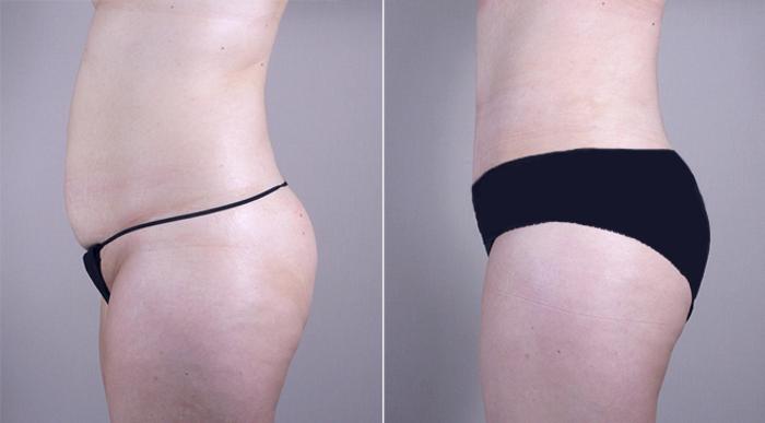 Mommy Makeover Case 376 Before & After View #4 | Paramus, New Jersey | Parker Center for Plastic Surgery
