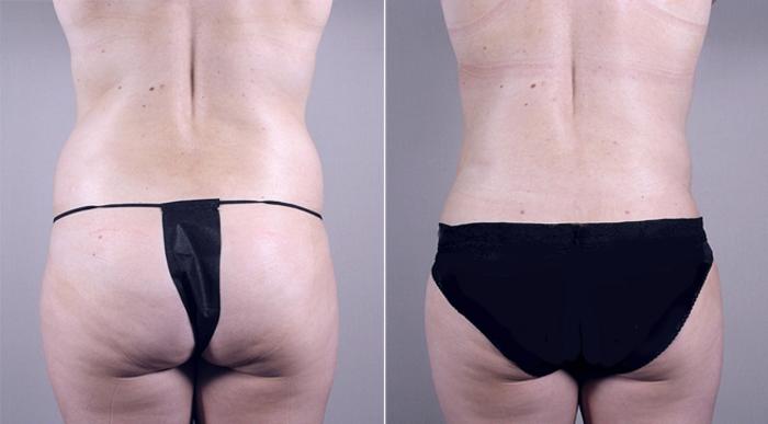 Mommy Makeover Case 376 Before & After View #5 | Paramus, New Jersey | Parker Center for Plastic Surgery