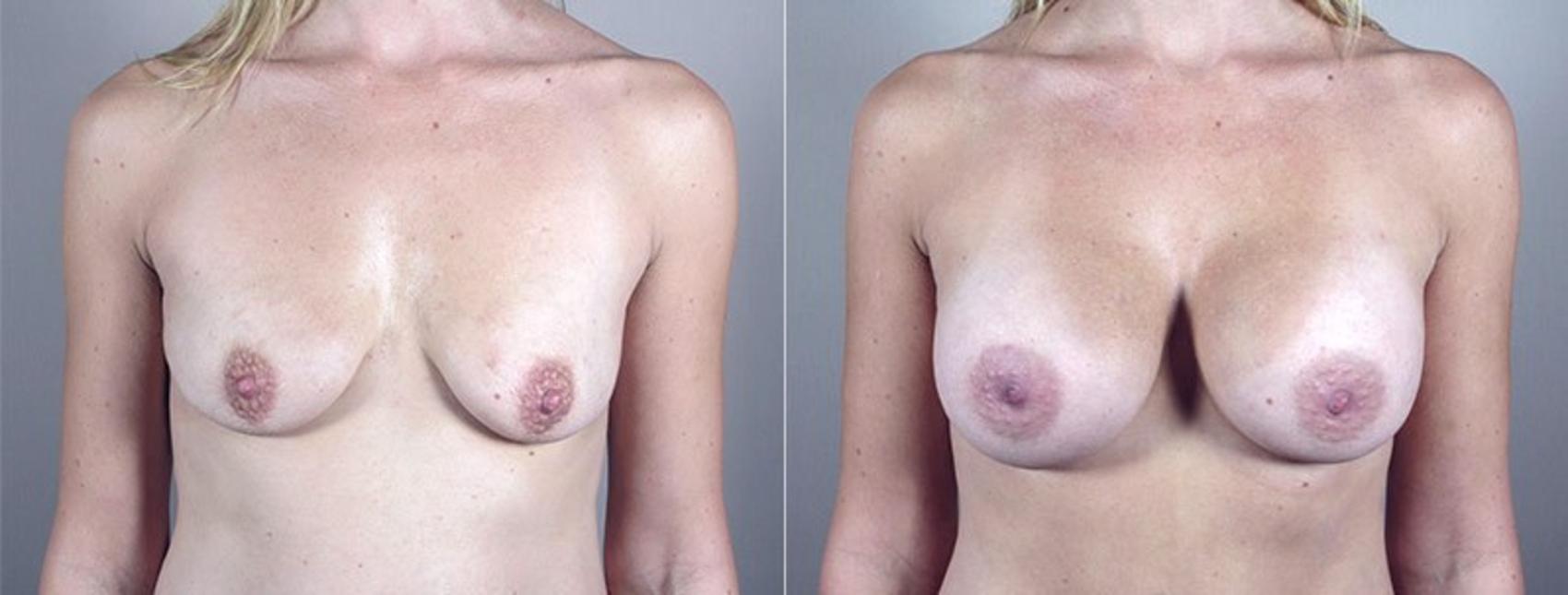 Mommy Makeover Case 381 Before & After View #1 | Paramus, New Jersey | Parker Center for Plastic Surgery