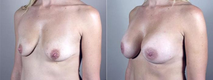 Mommy Makeover Case 381 Before & After View #2 | Paramus, New Jersey | Parker Center for Plastic Surgery