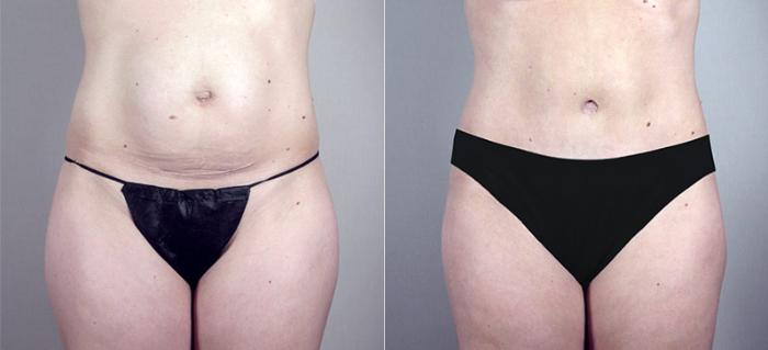 Mommy Makeover Case 381 Before & After View #3 | Paramus, New Jersey | Parker Center for Plastic Surgery