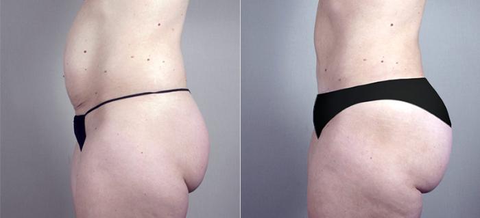 Mommy Makeover Case 381 Before & After View #4 | Paramus, New Jersey | Parker Center for Plastic Surgery