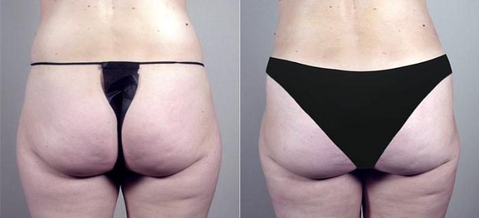 Mommy Makeover Case 381 Before & After View #5 | Paramus, New Jersey | Parker Center for Plastic Surgery