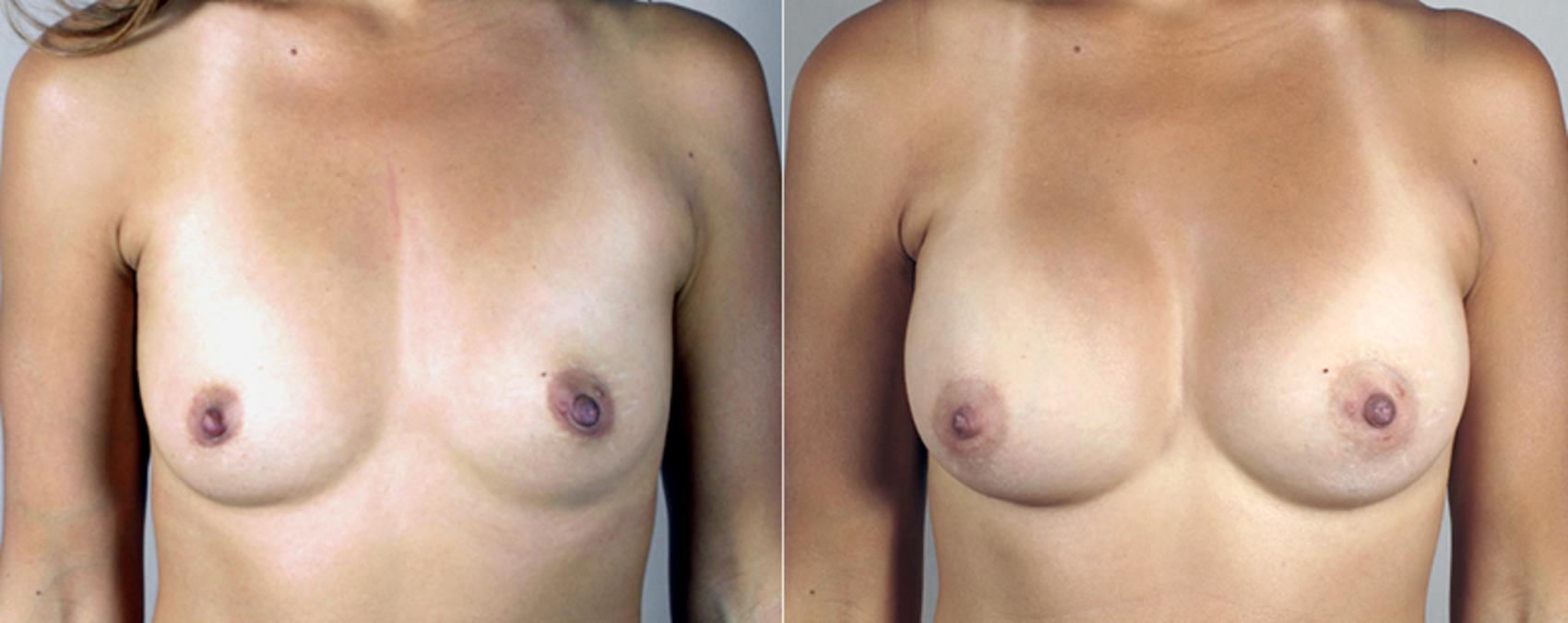 Mommy Makeover Case 382 Before & After View #1 | Paramus, New Jersey | Parker Center for Plastic Surgery