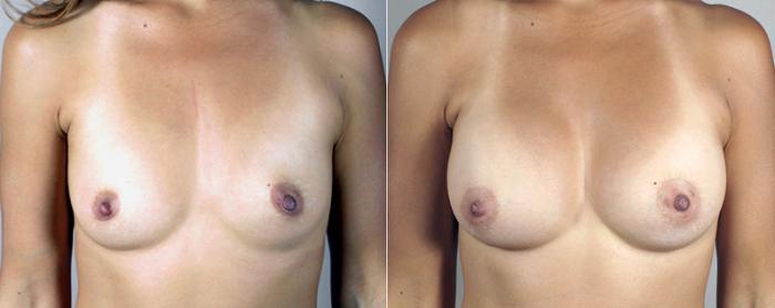Mommy Makeover Case 382 Before & After View #1 | Paramus, New Jersey | Parker Center for Plastic Surgery
