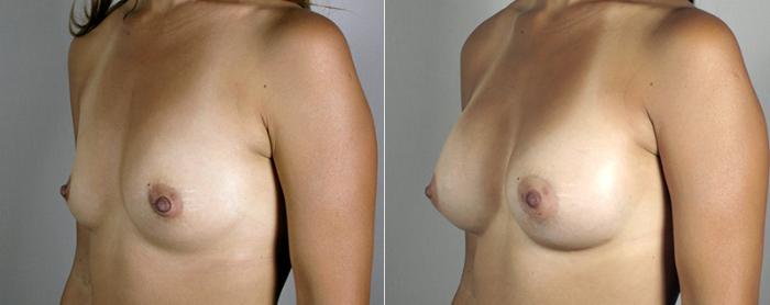 Mommy Makeover Case 382 Before & After View #2 | Paramus, New Jersey | Parker Center for Plastic Surgery