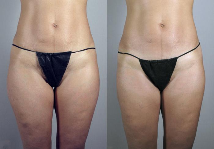Mommy Makeover Case 382 Before & After View #3 | Paramus, New Jersey | Parker Center for Plastic Surgery