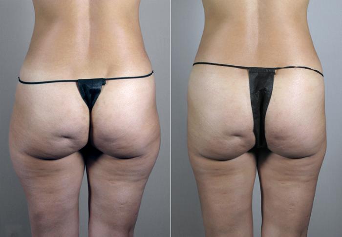 Mommy Makeover Case 382 Before & After View #4 | Paramus, New Jersey | Parker Center for Plastic Surgery