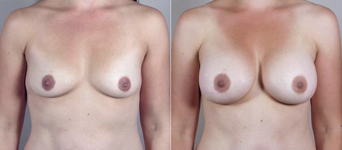Mommy Makeover Case 383 Before & After View #1 | Paramus, New Jersey | Parker Center for Plastic Surgery