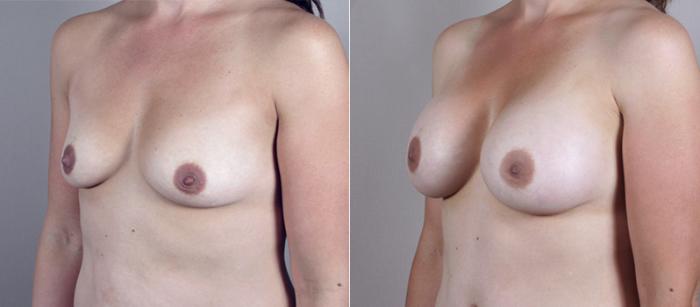 Mommy Makeover Case 383 Before & After View #2 | Paramus, New Jersey | Parker Center for Plastic Surgery