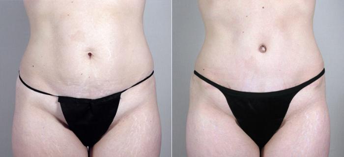 Mommy Makeover Case 383 Before & After View #3 | Paramus, New Jersey | Parker Center for Plastic Surgery