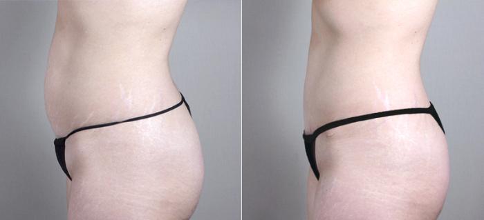 Mommy Makeover Case 383 Before & After View #4 | Paramus, New Jersey | Parker Center for Plastic Surgery