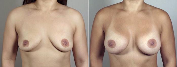 Mommy Makeover Case 406 Before & After View #1 | Paramus, New Jersey | Parker Center for Plastic Surgery