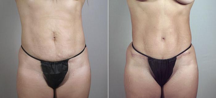 Mommy Makeover Case 406 Before & After View #3 | Paramus, New Jersey | Parker Center for Plastic Surgery