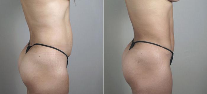 Mommy Makeover Case 406 Before & After View #4 | Paramus, New Jersey | Parker Center for Plastic Surgery