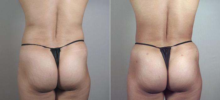 Mommy Makeover Case 406 Before & After View #5 | Paramus, New Jersey | Parker Center for Plastic Surgery
