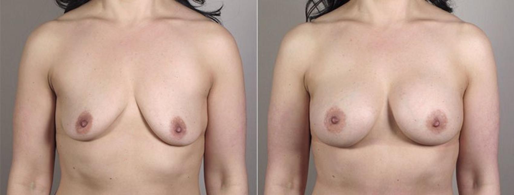 Mommy Makeover Case 407 Before & After View #1 | Paramus, New Jersey | Parker Center for Plastic Surgery