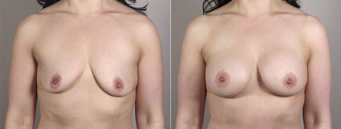 Mommy Makeover Case 407 Before & After View #1 | Paramus, New Jersey | Parker Center for Plastic Surgery