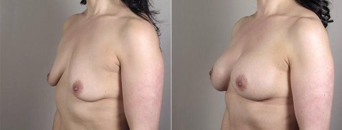 Mommy Makeover Case 407 Before & After View #2 | Paramus, New Jersey | Parker Center for Plastic Surgery