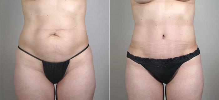 Mommy Makeover Case 407 Before & After View #3 | Paramus, New Jersey | Parker Center for Plastic Surgery