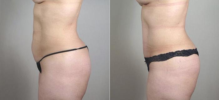 Mommy Makeover Case 407 Before & After View #4 | Paramus, New Jersey | Parker Center for Plastic Surgery