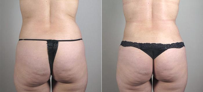 Mommy Makeover Case 407 Before & After View #5 | Paramus, New Jersey | Parker Center for Plastic Surgery
