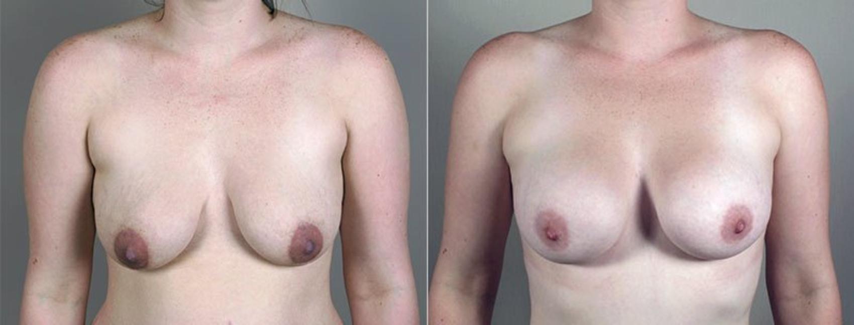 Mommy Makeover Case 408 Before & After View #1 | Paramus, New Jersey | Parker Center for Plastic Surgery